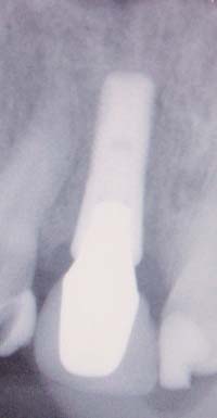 clear choice dental implant